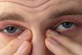 Dealing With Irritated Eyes